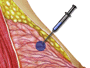 Once the tip of the needle has penetrated the lump, the doctor will draw material from the lump up into the collection chamber.