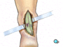 The sheath is then opened to reveal the tendon itself and the contained,