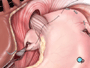 your doctor wraps the upper portion of the stomach around the esophagus and sutures it into place.