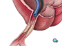 Once the restricted area has been identified, a thin wire is inserted into the catheter, and is guided all the way to the blocked area and then slightly beyond.
