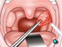 Using a clamp, the surgeon will pull the tonsils toward the middle of the mouth.