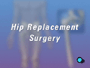 When it comes to hip replacement surgery, there are no real alternatives.