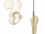 Then, the surgical team will use a high-speed drill to hollow out the top of the thighbone.