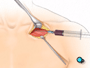 Using a special needle and syringe, your doctor will puncture the wall of the vein.