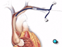 and a catheter - or hollow tube - is passed over the guide wire and into the heart.