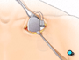 the pacemaker is inserted into the pocket below the collar bone