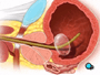 A Foley catheter is a narrow tube inserted through your urethra and into your bladder.  The catheter is connected to a bag that is attached to your leg by a strap.  While the Foley catheter is in place, urine will pass from your bladder into the bag.  You will not need to urinate into a toilet.