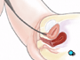 A well-lubricated cystoscope is gently inserted into the urethra and slowly guided inward.