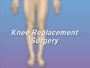 When it comes to knee replacement surgery, there are no real alternatives.